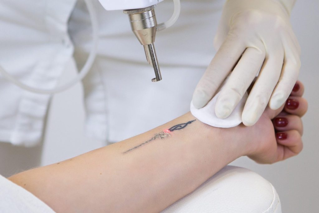 tattoo removal derby